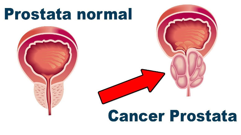 Los tratamientos del cáncer de próstata