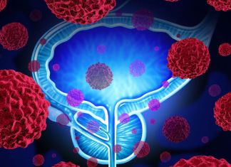 Consejos de un canceroso de próstata