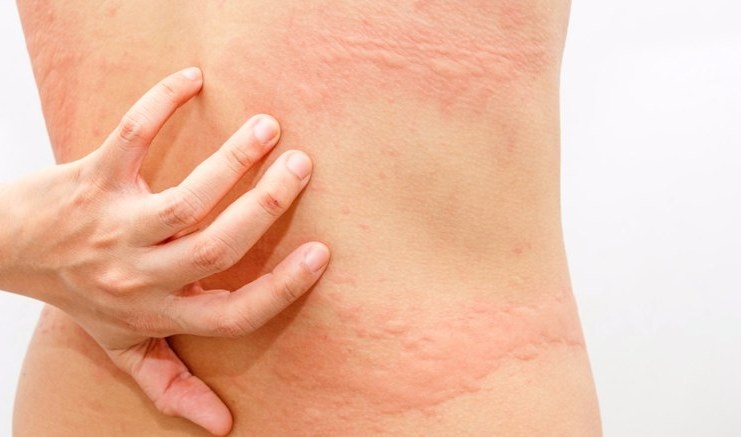 URTICARIA