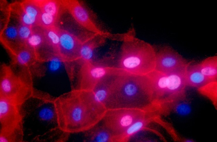 Mitos y creencias no ciertas sobre cáncer de mama