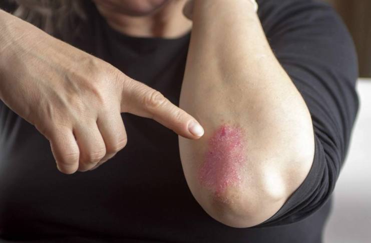 Psoriasis y artritis psoriásica, enfermedades vinculadas que requieren pronta detección