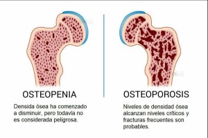 Manejo de la osteopenia y la osteoporosis