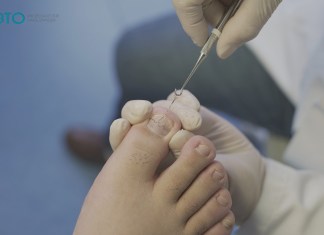 Uña encarnada: Esto debo conocer del padecimiento