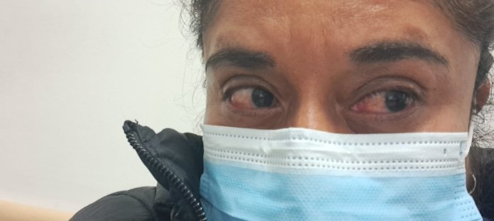 La diputada Karina Paz publicó fotografías de los daños en los ojos del equipo de auditores de la Contraloría General de Cuentas (CGC) al ser expuestos a luz UVC en el Hospital de Especialidades Rodolfo Robles de Quetzaltenango. Foto: X de diputada Karina Paz