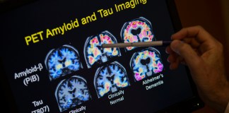 ARCHIVO - Un médico señala imágenes de un escáner cerebral dentro de un estudio sobre el Alzheimer en el hospital de la Universidad de Georgetown, el martes 19 de mayo de 2015 en Washington. (AP Foto/Evan Vucci, Achivo)