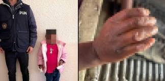 PGN rescata a niña con quemaduras en las manos presuntamente por no realizar las tareas del hogar