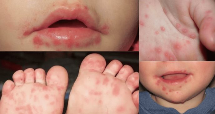 Sacatepéquez registra actualmente 133 casos de virus de manos, pies y boca. Foto La Hora: Medicina y Salud Pública.
