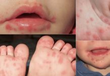 Virus de manos, pies y boca: Sacatepéquez y tres departamentos más con mayor reporte de casos Sacatepéquez registra actualmente 133 casos de virus de manos, pies y boca. Foto La Hora: Medicina y Salud Pública.
