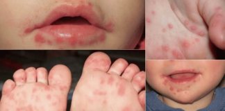 Sacatepéquez registra actualmente 133 casos de virus de manos, pies y boca. Foto La Hora: Medicina y Salud Pública.