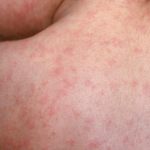 Imágenes con fines ilustrativos de los síntomas del Sarampión. Foto La Hora: CNN en español