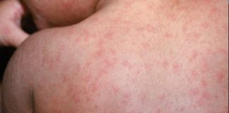 Imágenes con fines ilustrativos de los síntomas del Sarampión. Foto La Hora: CNN en español