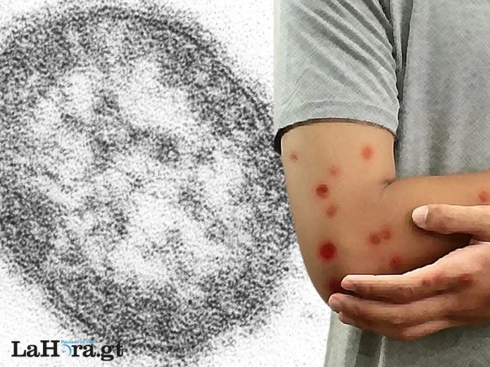 Alerta de la OPS por sarampión permite a Guatemala mayor vigilancia y respuesta sanitaria de posibles brotes.