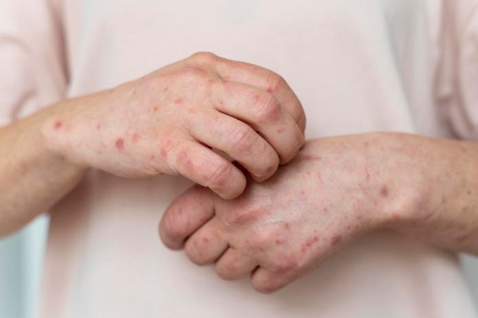 skin-allergy-person-s-arm (1) Los casos positivos de sarampión están relacionados con la celebración masiva registrada en Santiago Atitlán, Sololá, y han sido identificados en al menos 8 departamentos. Foto La Hora: Freepik.