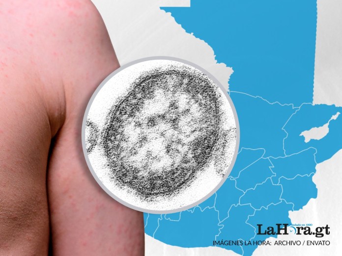 El Ministerio de Salud contabiliza 868 casos de sarampión y ha lanzado una campaña de vacunación para buscar frenar la enfermedad viral.