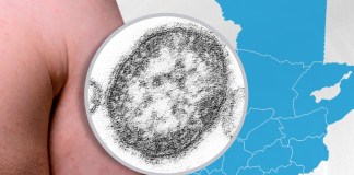 El Ministerio de Salud contabiliza 868 casos de sarampión y ha lanzado una campaña de vacunación para buscar frenar la enfermedad viral.