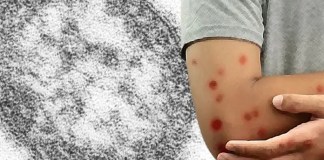 De 868 casos contabilizados la semana pasada por el ministerio de Salud, la cifra aumentó a 1,309 en estos días.