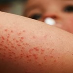 Dos menores de edad fallecen tras complicaciones de salud por caso de sarampión.