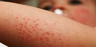 Dos menores de edad fallecen tras complicaciones de salud por caso de sarampión.