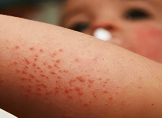 Dos menores de edad fallecen tras complicaciones de salud por caso de sarampión.