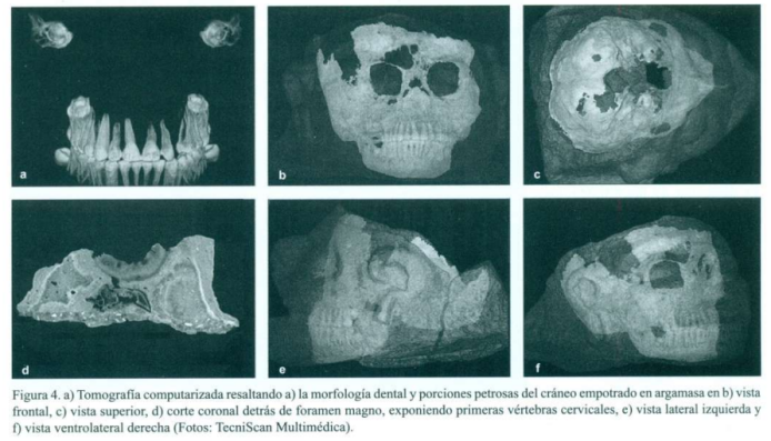Radiografía de cráneo que se encuentra en el interior de una pieza arqueológica cubierta con estuco. Foto La Hora: Mexicon