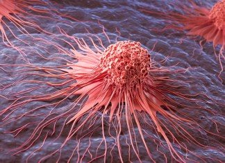 El cáncer puede ser diferente entre personas, aún cuando está en el mismo órgano. Foto: Anusorn Nakdee / Shutterstock.